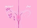 هشدار درباره شیوع اندومتریوز در زنان