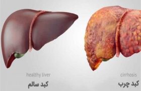 هشدار وزارت بهداشت درباره درمان اشتباه کبد چرب با این مواد غذایی