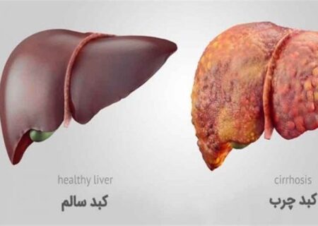 هشدار وزارت بهداشت درباره درمان اشتباه کبد چرب با این مواد غذایی