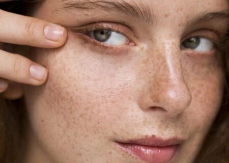 آشنایی با انواع لک‌های پوستی