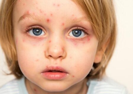 این گروه واکسن آبله‌مرغان بزنند