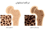 برای افزایش تراکم استخوان چه بخوریم؟/ نمونه برنامه غذایی روزانه مبتلایان به استئوپنی/ ورزش‌های مناسب تراکم استخوان 