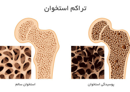 برای افزایش تراکم استخوان چه بخوریم؟/ نمونه برنامه غذایی روزانه مبتلایان به استئوپنی/ ورزش‌های مناسب تراکم استخوان 