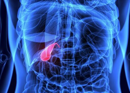 برداشتن کیسه صفرا تنها راه خلاصی از سنگ‌های صفراوی است؟/ کنترل سنگ صفرا به سبک طب سنتی 