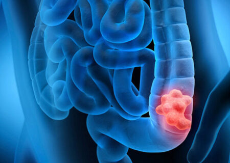 تدین: سن ابتلا به سرطان روده بزرگ در ایران کاهش نگران‌کننده دارد