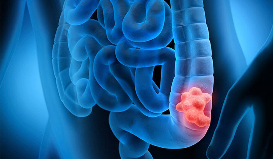 تدین: سن ابتلا به سرطان روده بزرگ در ایران کاهش نگرانکننده دارد