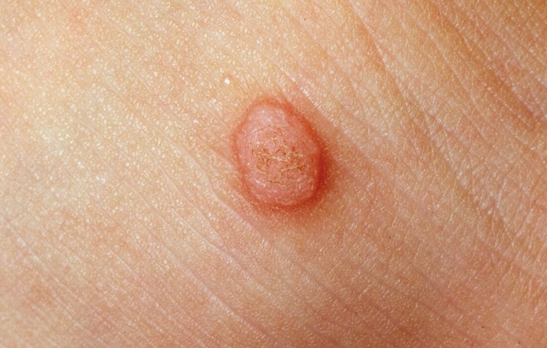 تفاوت خال گوشتی و زگیل چیست؟/ آیا کندن  زگیل با ناخنگیر یا بستن نخ خطرناک است؟