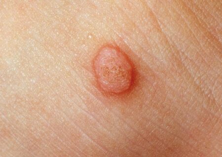 تفاوت خال گوشتی و زگیل چیست؟/ آیا کندن  زگیل با ناخنگیر یا بستن نخ خطرناک است؟