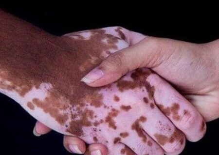 روشی برای کاهش لک‌های پوستی در ایران