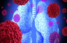 علت ۸۵ درصد سرطان‌های ریه