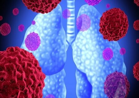 علت ۸۵ درصد سرطان‌های ریه