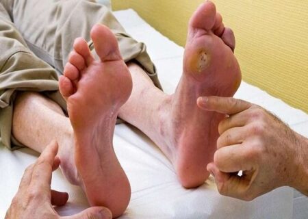 زخم پای دیابتی عارضه‌ای خاموش اما خطرناک