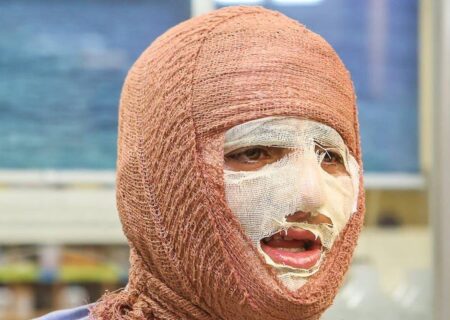 سوختگی؛ آسیب جسمی و روانی که فراتر از درمان است
