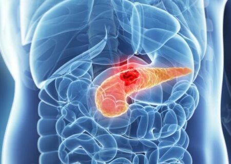 شناسایی علامت هشدار دهنده اولیه سرطان معروف به «قاتل خاموش»