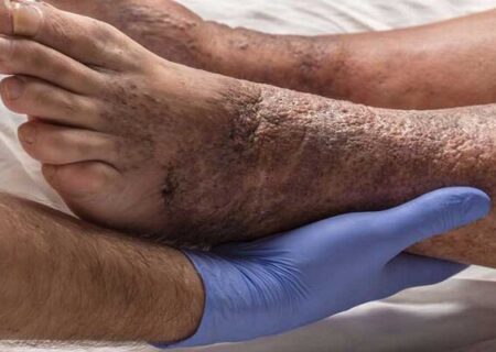 ۱۵ درصد دیابتی‌ها دچار زخم دیابت می‌شوند