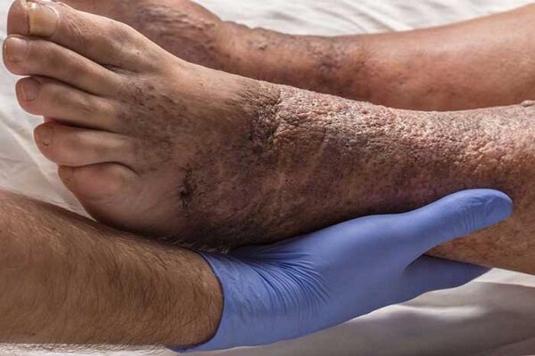 ۱۵ درصد دیابتی‌ها دچار زخم دیابت می‌شوند