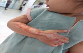 توصیه‌هایی برای پیشگیری از سوختگی