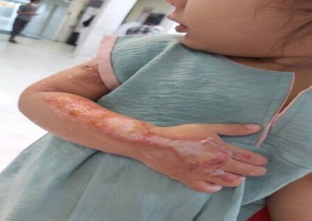 توصیه‌هایی برای پیشگیری از سوختگی