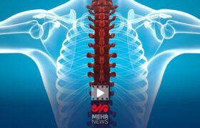 فلج اندام‌ها از عوارض شکستن قلنج توسط ماساژورها