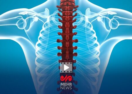 فلج اندام‌ها از عوارض شکستن قلنج توسط ماساژورها