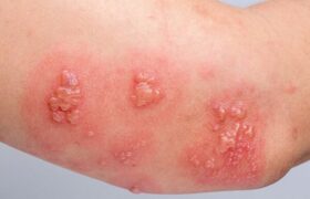 ویژگی‌های خاص واکسن زونا