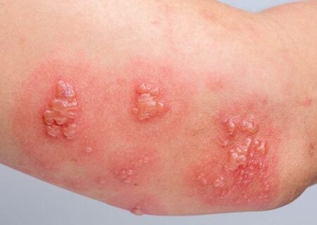 ویژگی‌های خاص واکسن زونا