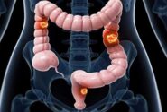 عوامل ابتلا به سرطان روده بزرگ را بشناسیم