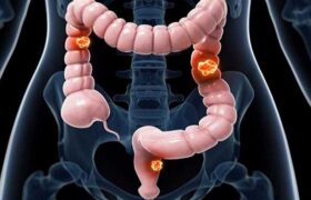 عوامل ابتلا به سرطان روده بزرگ را بشناسیم