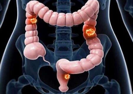 عوامل ابتلا به سرطان روده بزرگ را بشناسیم