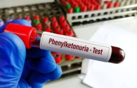 خبر خوش برای بیماران PKU؛ توزیع نان فاقد پروتئین