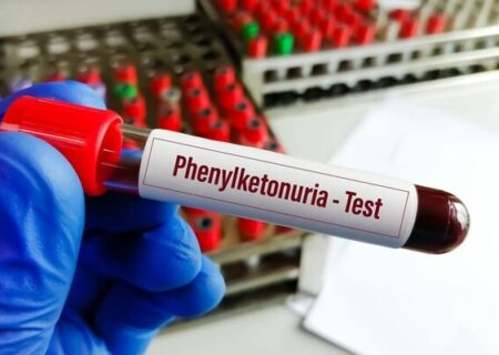 خبر خوش برای بیماران PKU؛ توزیع نان فاقد پروتئین