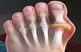 داروهای نقرس به سلامت قلب نیز کمک می‌کنند