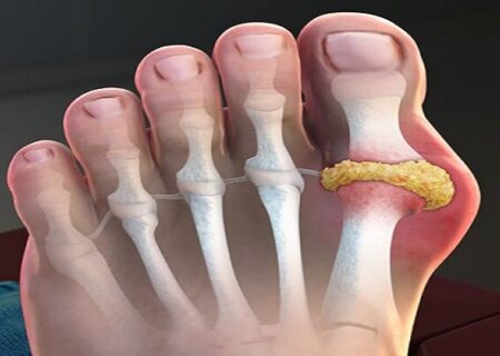 داروهای نقرس به سلامت قلب نیز کمک می‌کنند